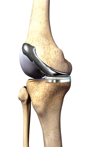 Customized Knee Replacements