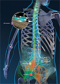 Spinal Cord Stimulator industry insight