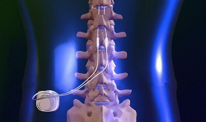 Spinal Cord Stimulator industry insight