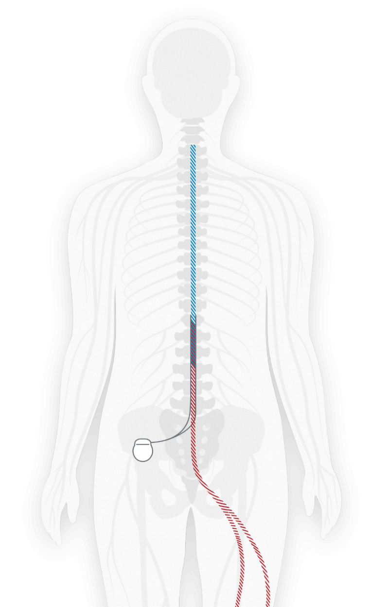 Spinal Cord Stimulator industry insight